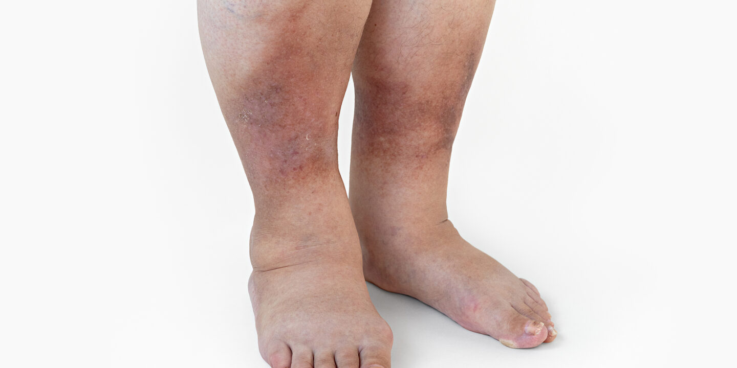 Diabetic Leg Swelling Treatment Surviving Diabetes